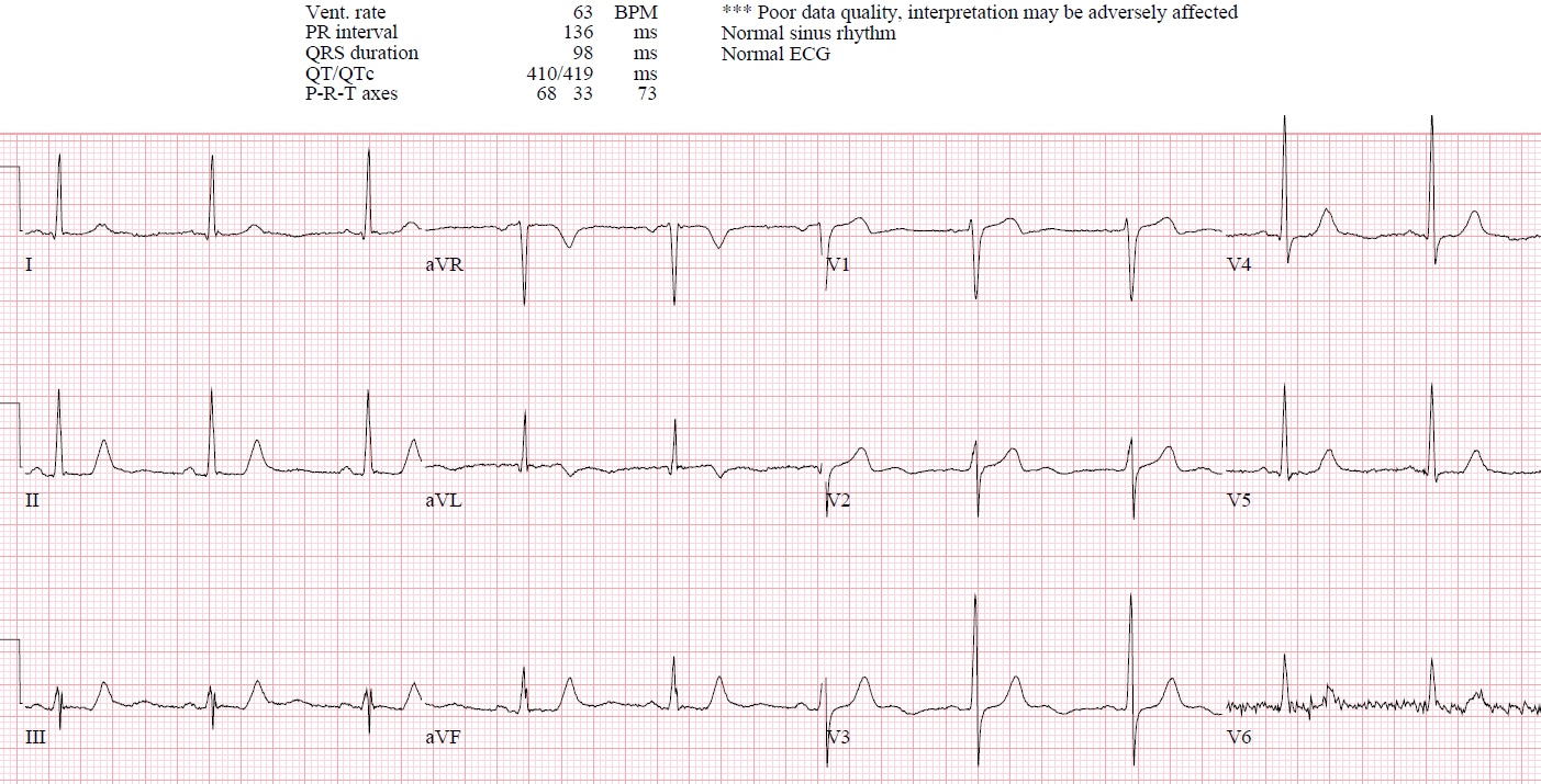 Reciprocal Changes and Occlusion MI ECG Cases Emergency Medicine Cases