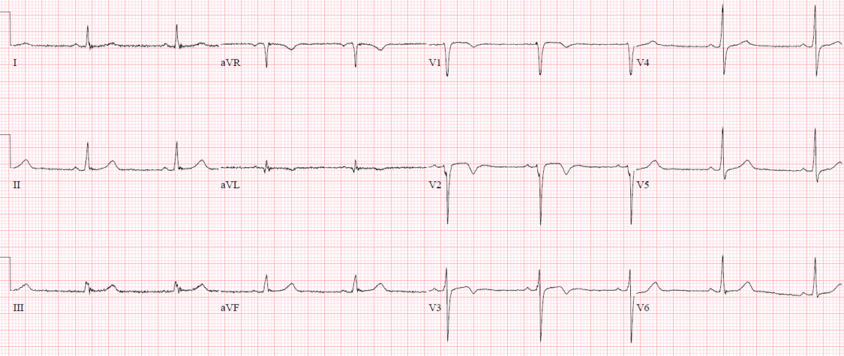 Reciprocal Changes and Occlusion MI | ECG Cases | Emergency Medicine Cases