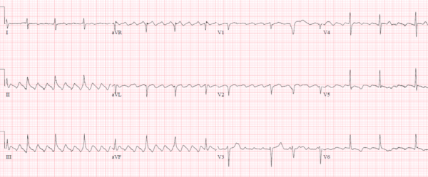 ECG Approach to Atrial Fibrillation | ECG Cases | Emergency Medicine Cases