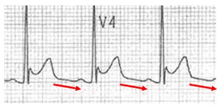 Pericarditis and Cardiac Tamponade | Emergency Medicine Cases