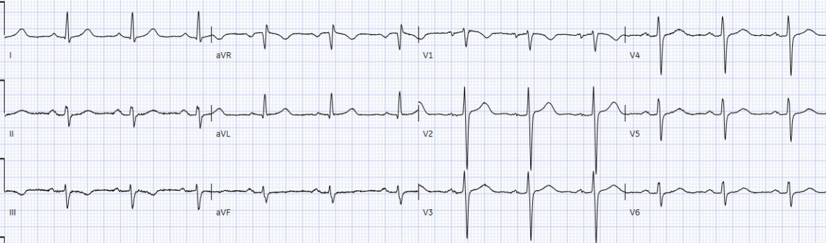 Sudden cardiac death - Brugada syndrome | ECG Cases | EM Cases