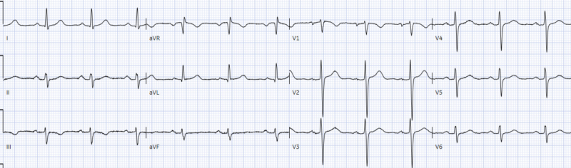 Sudden cardiac death - Brugada syndrome | ECG Cases | EM Cases