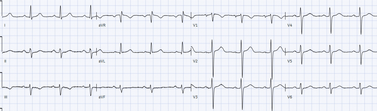 Sudden cardiac death - Brugada syndrome | ECG Cases | EM Cases