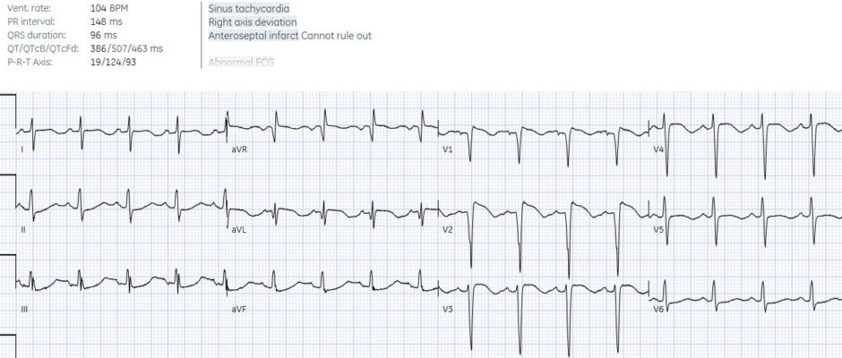 Sudden cardiac death - Brugada syndrome | ECG Cases | EM Cases