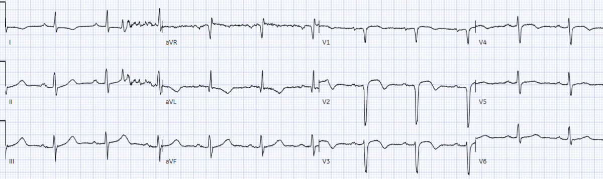 Sudden cardiac death - Brugada syndrome | ECG Cases | EM Cases