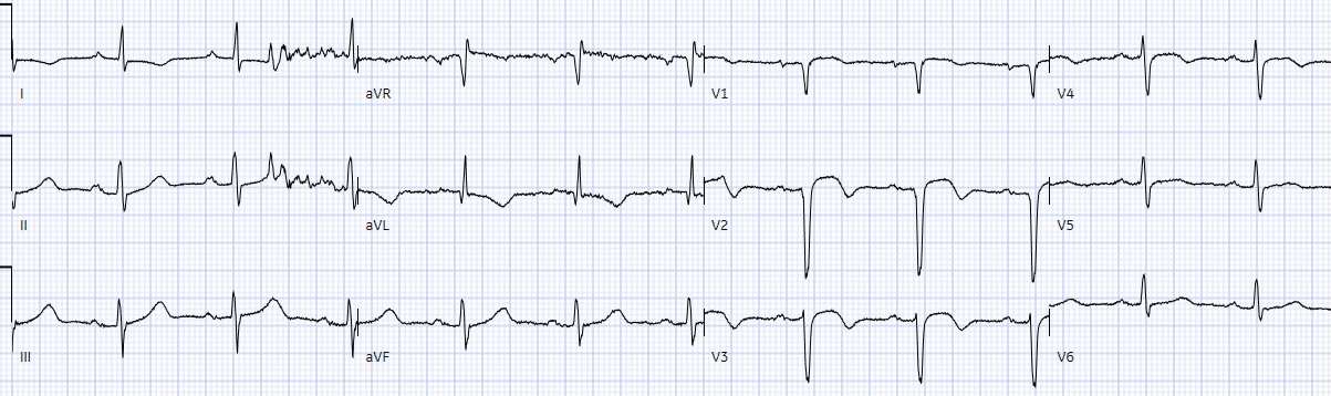 Sudden cardiac death - Brugada syndrome | ECG Cases | EM Cases