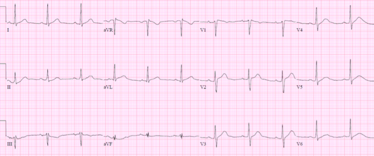 Sudden cardiac death - Brugada syndrome | ECG Cases | EM Cases