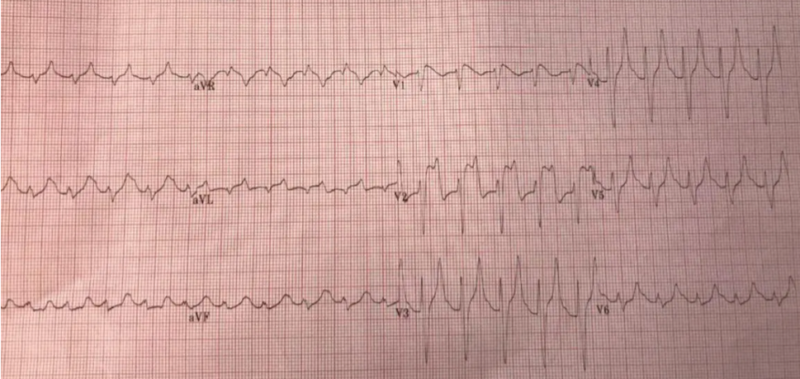 Sudden cardiac death - Brugada syndrome | ECG Cases | EM Cases