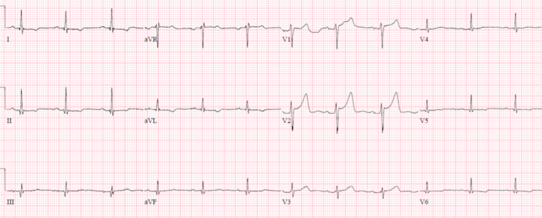 Sudden cardiac death - Brugada syndrome | ECG Cases | EM Cases