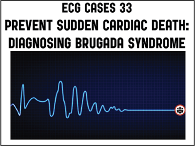 Sudden cardiac death - Brugada syndrome | ECG Cases | EM Cases