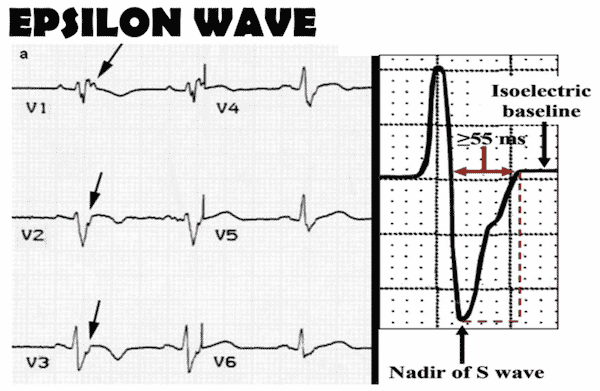 ARVC epsilon wave