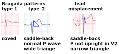 Brugada ECG