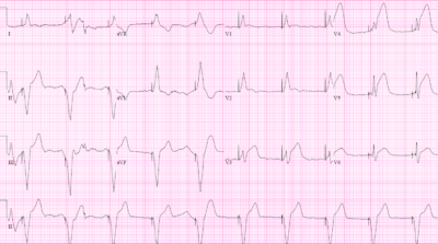 PACER mnemonic approach to pacemaker patients | ECG Cases | EM Cases