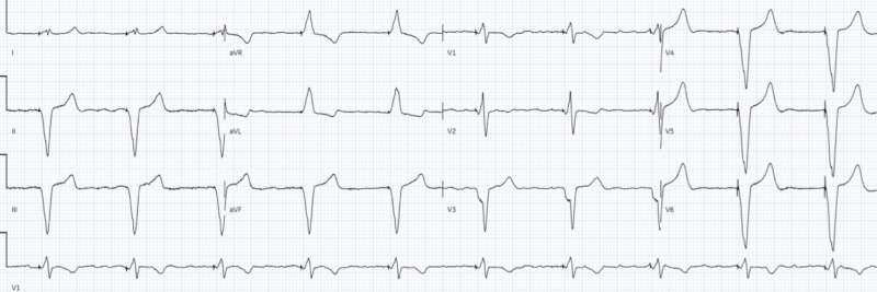 PACER mnemonic approach to pacemaker patients | ECG Cases | EM Cases