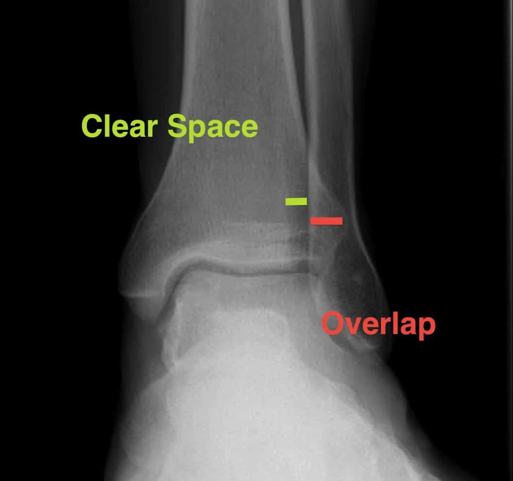 Emergency Orthopedics Differential Diagnosis SCARED OF Mnemonic EM 