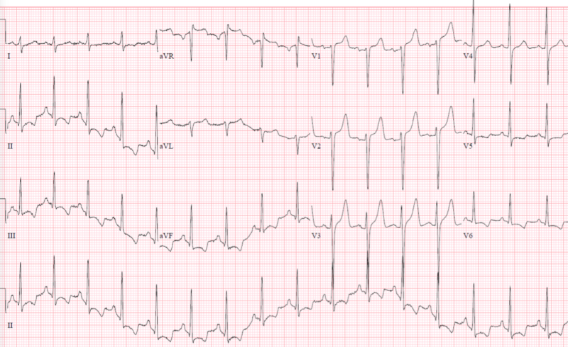 ECG interpretation in electrolyte emergencies | ECG Cases | EM Cases