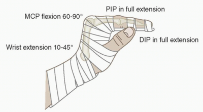 position of safe immobilization hand