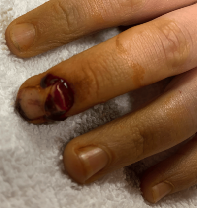 Fingernails | Advanced Health & Hand Therapy