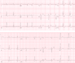 ECG Cases 41 - STEMI, Occlusion MI Complications