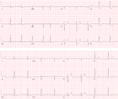 ECG Cases 41 - STEMI, Occlusion MI Complications