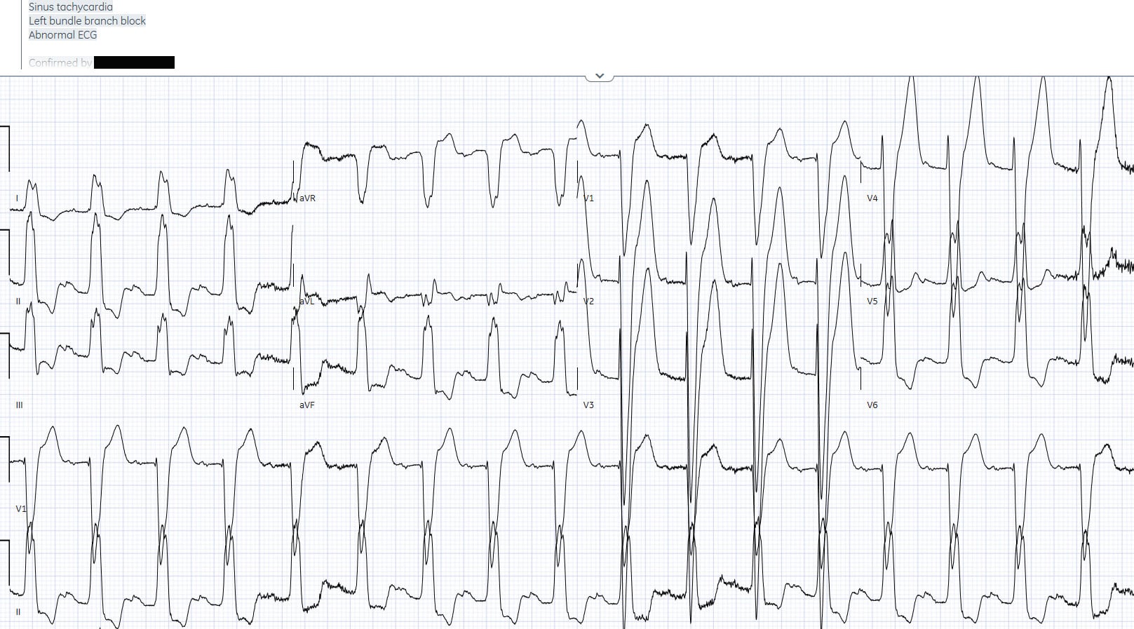 ECG Interpretation in Shortness of Breath ECG Cases EM Cases
