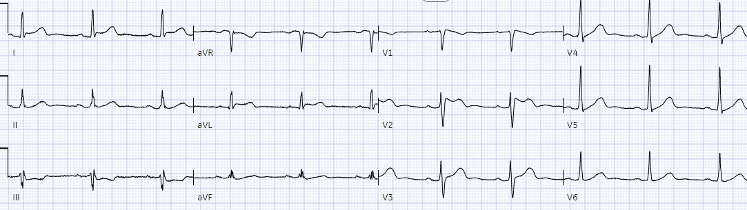 the-ecg-in-fever-and-infectious-disease-ecg-cases