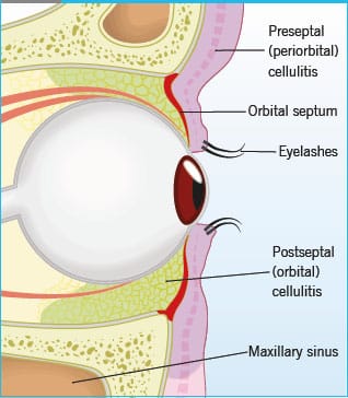 orbital septum