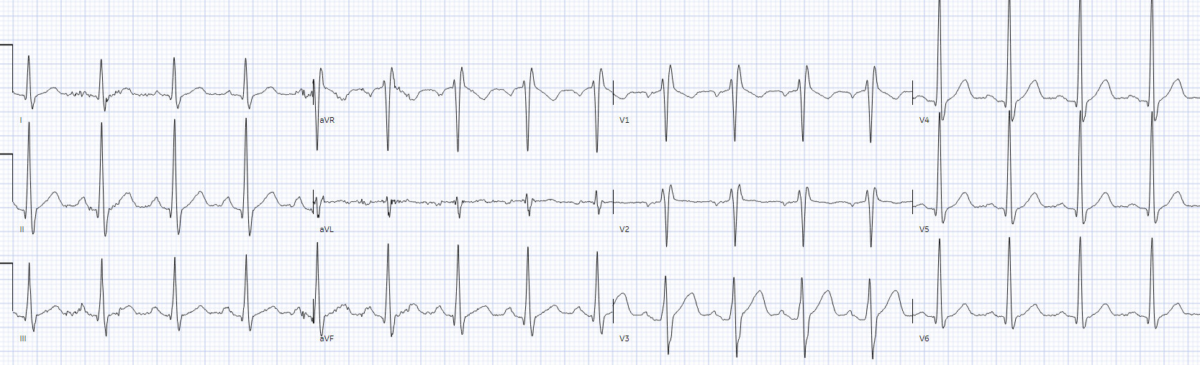 Can An Ekg Detect Drug Use ECG Interpretation in Toxicology | ECG Cases | EM Cases