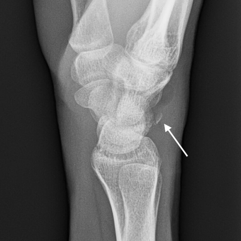 Carpal Bone Injuries The Big 4 Emergency Medicine Cases