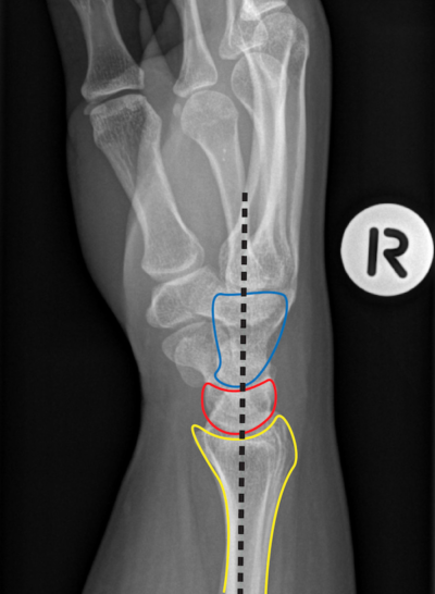 Commonly Missed Or Mismanaged Wrist Injuries Emergency Medicine Cases