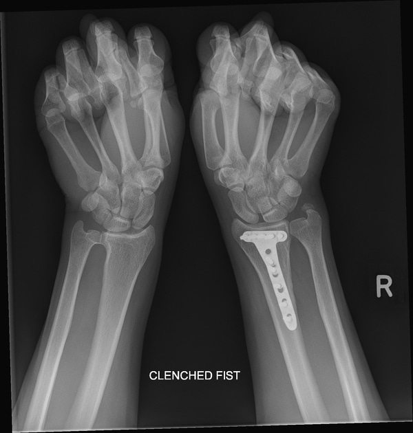 Bones Of The Hand And Wrist Xray
