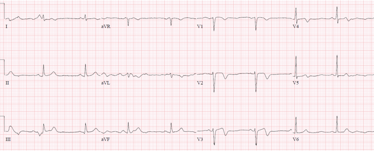ECGs falsely labeled normal | ECG Cases | EM Cases
