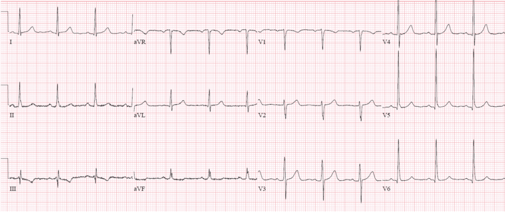 ECGs falsely labeled normal | ECG Cases | EM Cases