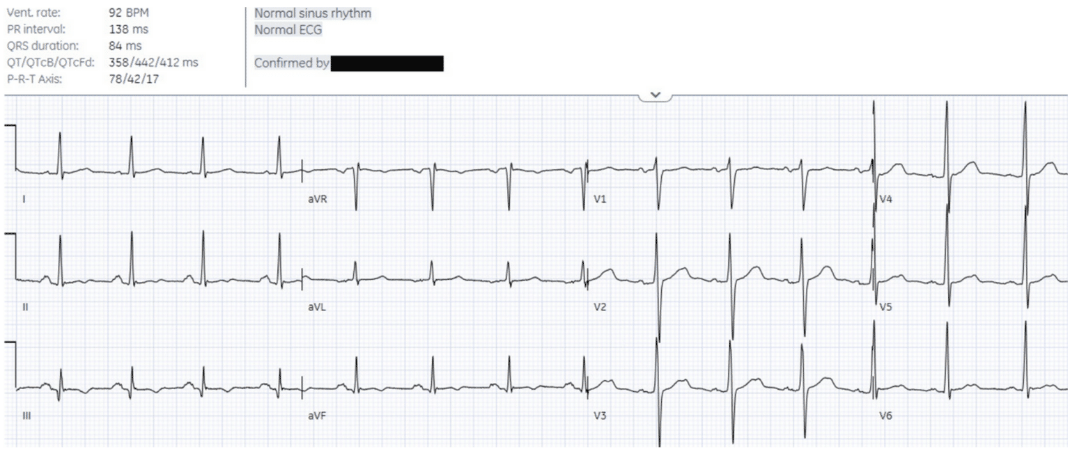 ECGs falsely labeled normal | ECG Cases | EM Cases