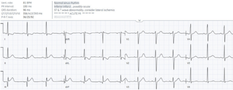 ECGs falsely labeled normal | ECG Cases | EM Cases