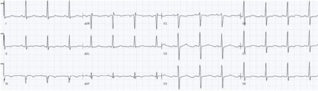 ECGs falsely labeled normal | ECG Cases | EM Cases