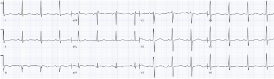 ECGs falsely labeled normal | ECG Cases | EM Cases