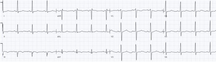 ECGs falsely labeled normal | ECG Cases | EM Cases