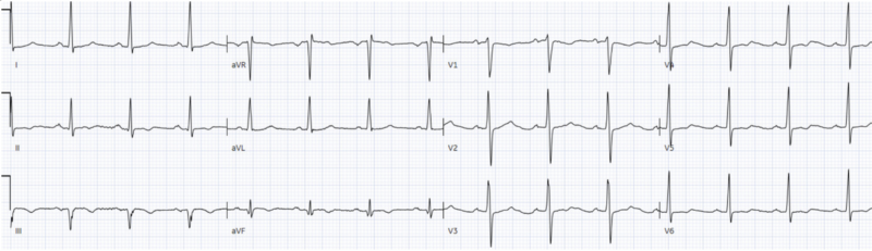 ECGs falsely labeled normal | ECG Cases | EM Cases