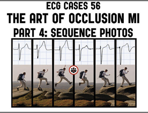 ECG Cases 56 – Art of Occlusion MI Part 4: Sequence Photos