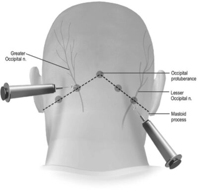 occipital nerve block landmarking