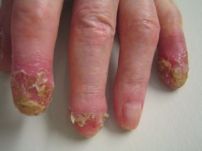 Acrodermatitis Hallopeau