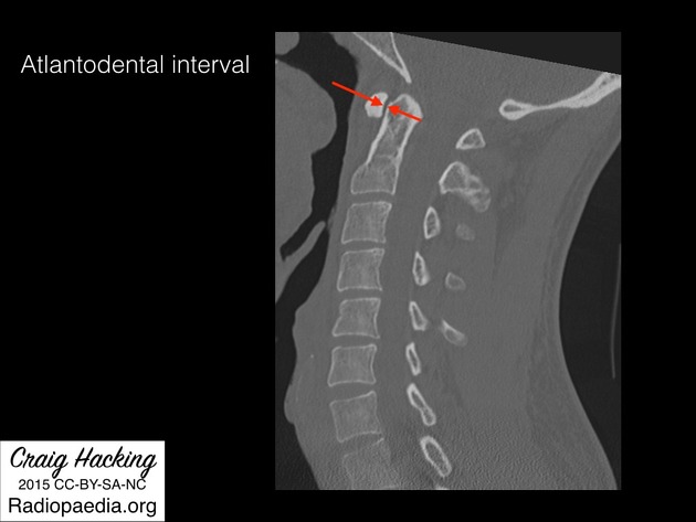 atlantodental interval