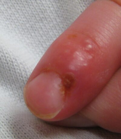 herpetic whiltlow