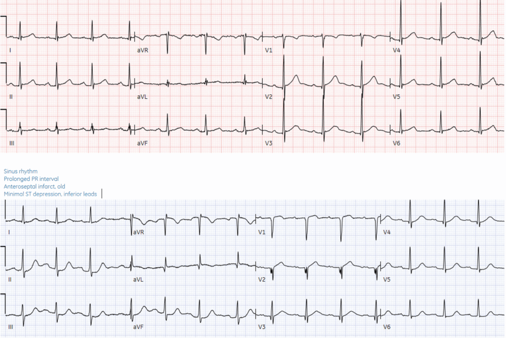 Normal Electrical Pathways H: normal sinus E: normal conduction A: normal axis R: acute loss of R ...