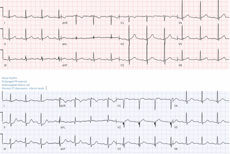 H: normal sinus E: normal conduction A: normal axis R: acute loss of R ...