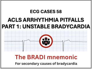 ECG Cases 58 ACLS dysrhythmia pitfall: Unstable Bradycardia The BRADIcardia mnemonic