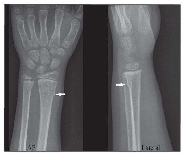 buckle fracture distal radius