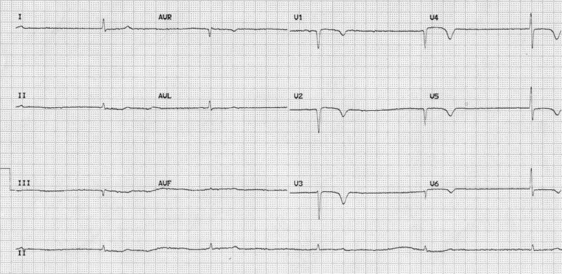 ECG decompensated hypothyroidism EM Cases
