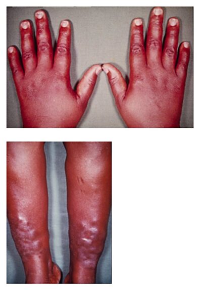 Pretibial myxedema